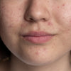 skin breakouts