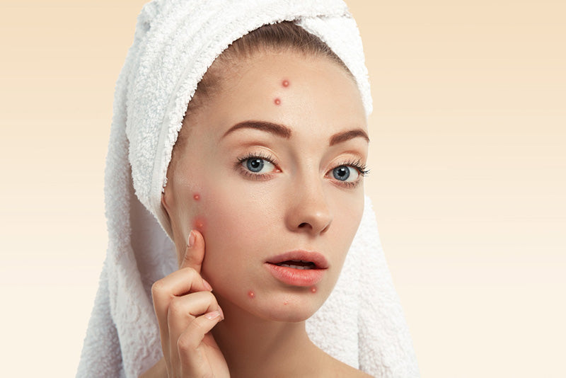 8 Top Tips for Managing Acne in Pakistan’s Climate