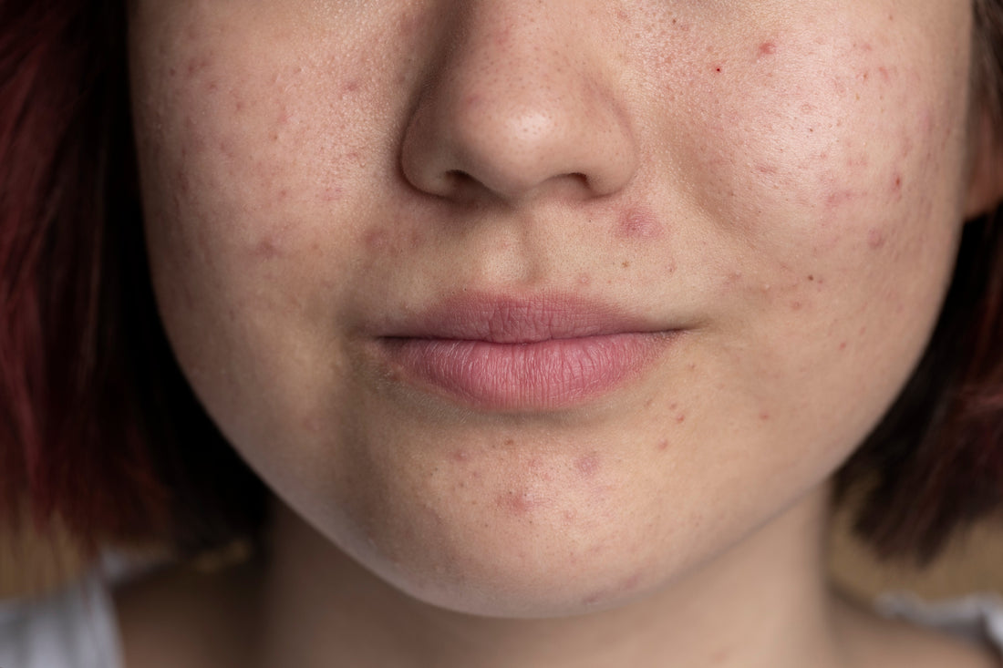 skin breakouts